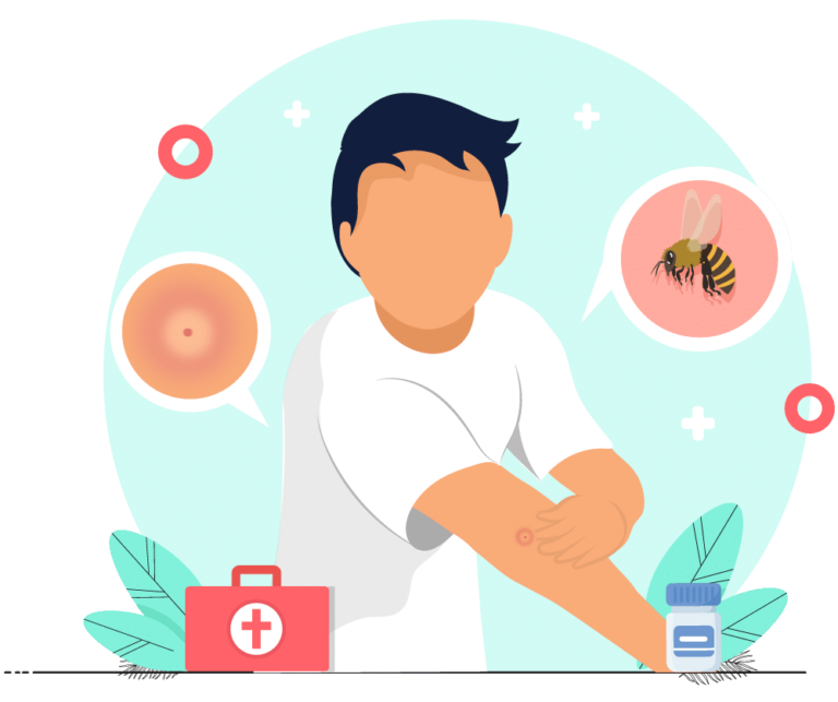 Piqûre d'abeille gonflement, démangeaison, allergie, que faire